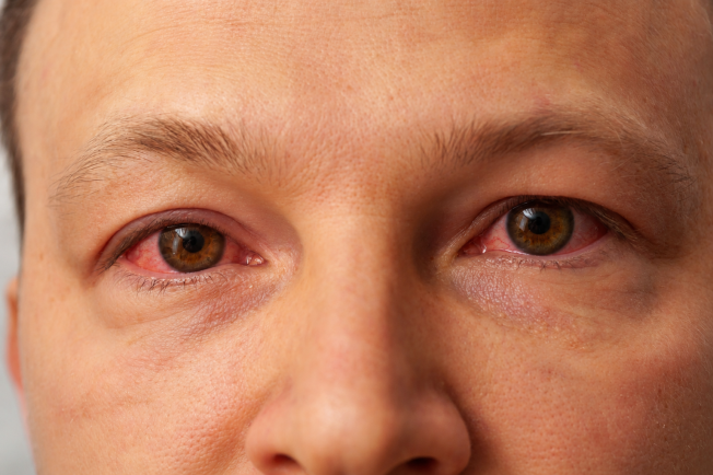 Ojos enrojecidos e irritados, uno de los síntomas frecuentes de la conjuntivitis.