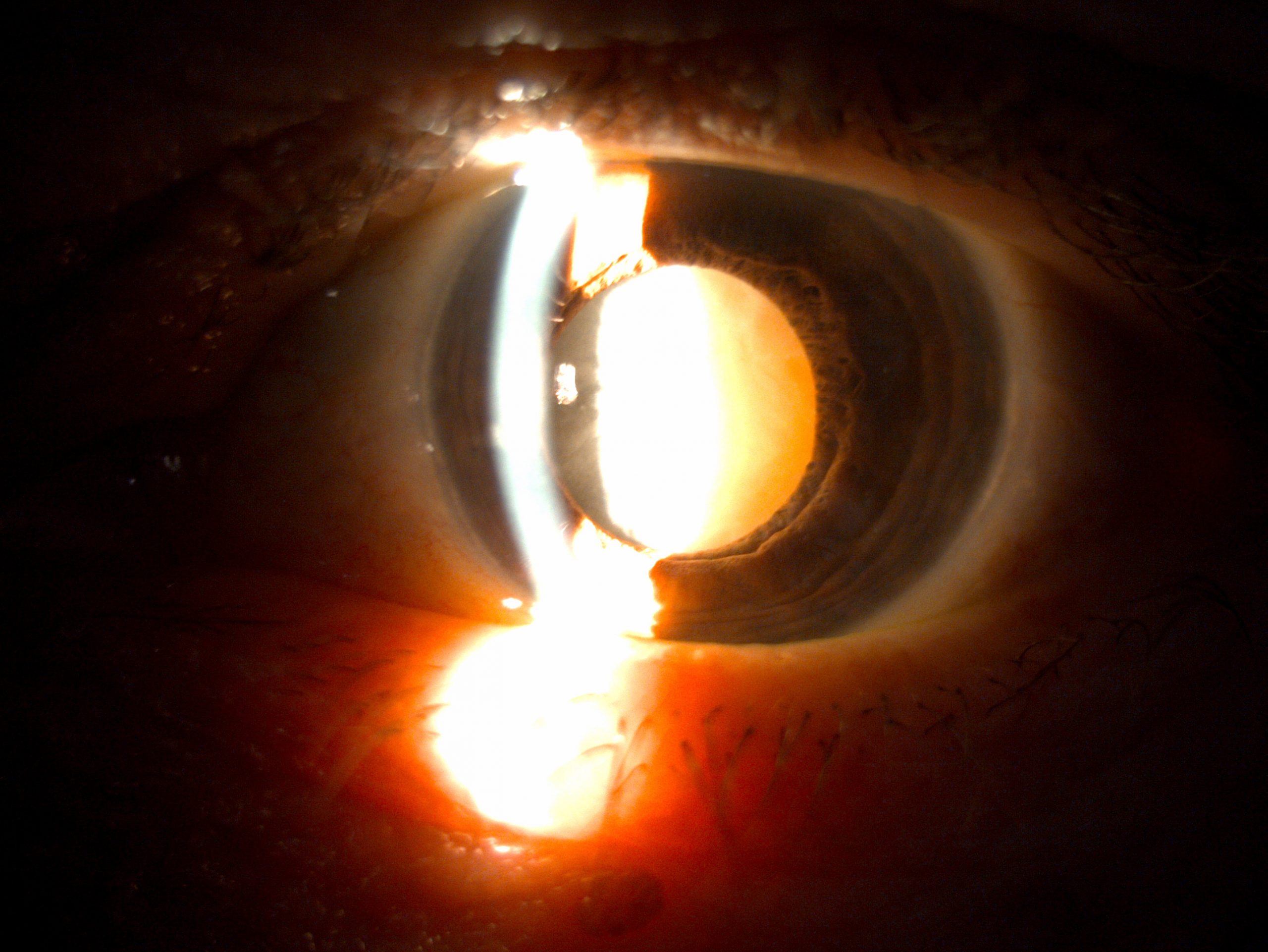 en que consiste operacion de cataratas