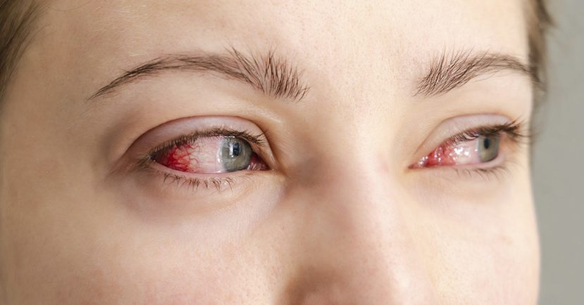 Tratamiento de la Hiperemia Conjuntival con Alfa-2 Selectivos 6 hiperemia conjuntival ojos rojos