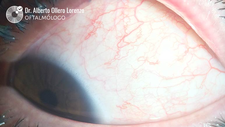 Colirio para ojos rojos: Marcas que nunca te recetará un oftalmólogo 1