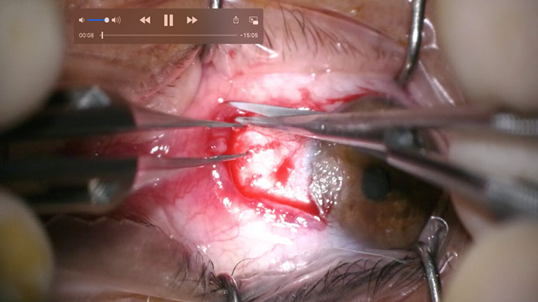 Cirugía de pterigium 3