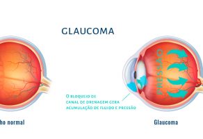 Glaucoma pseudoexfoliativo: una patología ocular de riesgo que exige vigilancia constante 3 tratamento glaucoma