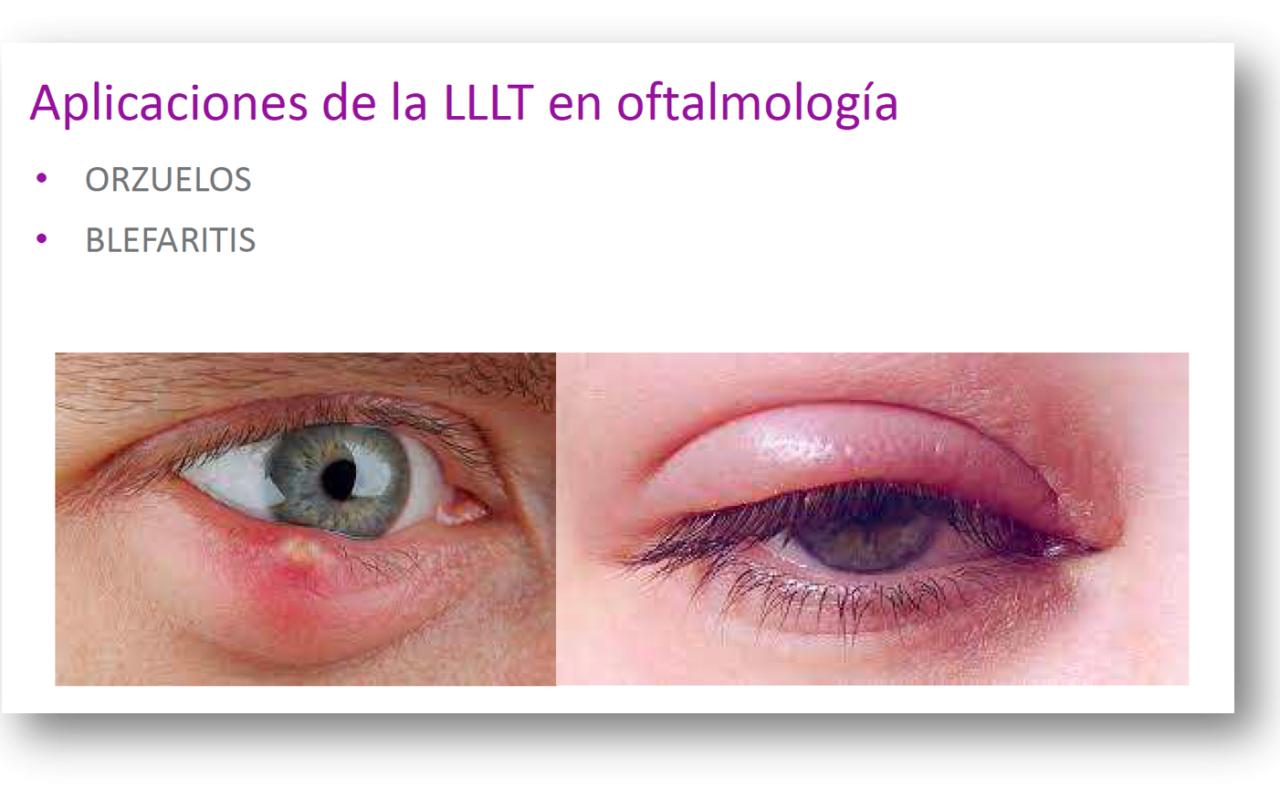 aplicaciones de la LLLT en oftalmología